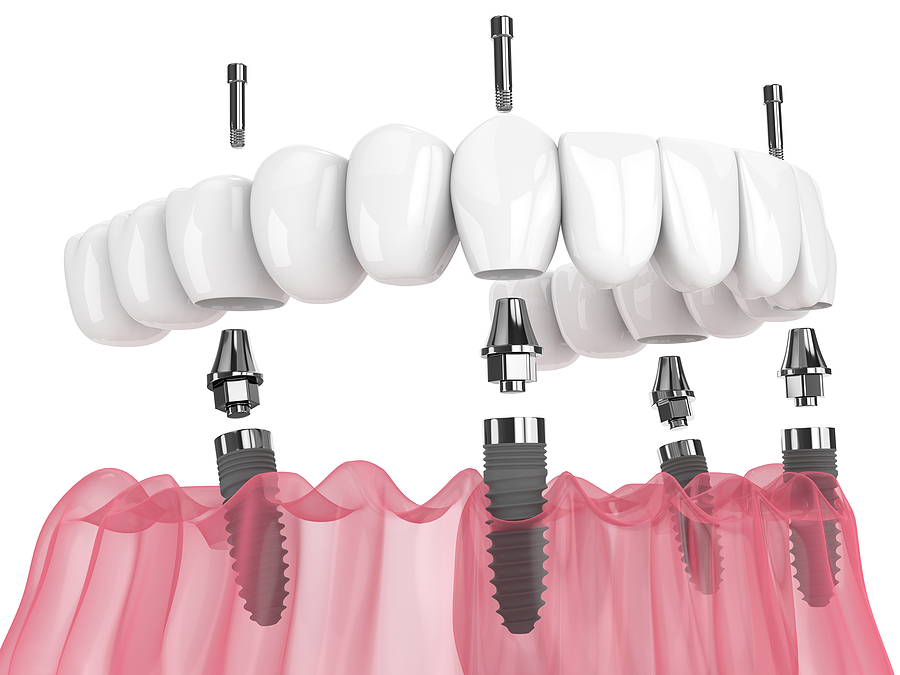 All-on-4® Dental Implants: A Permanent and Reliable Solution for Missing Teeth in Eagle Grove, IA