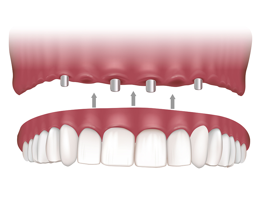 Transform Your Smile with All-on-4® Dental Implants in Eagle Grove, IA