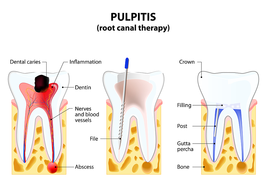 Pain-Free Solutions: Gentle Root Canal Therapy in Eagle Grove, IA