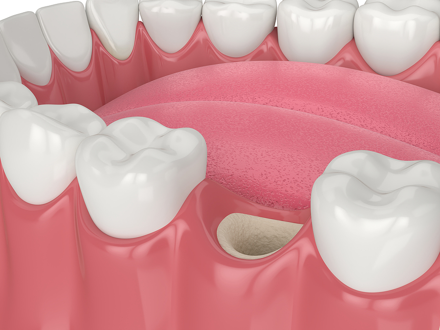 Preserving Your Smile: The Importance of Socket Preservation in Eagle Grove, IA